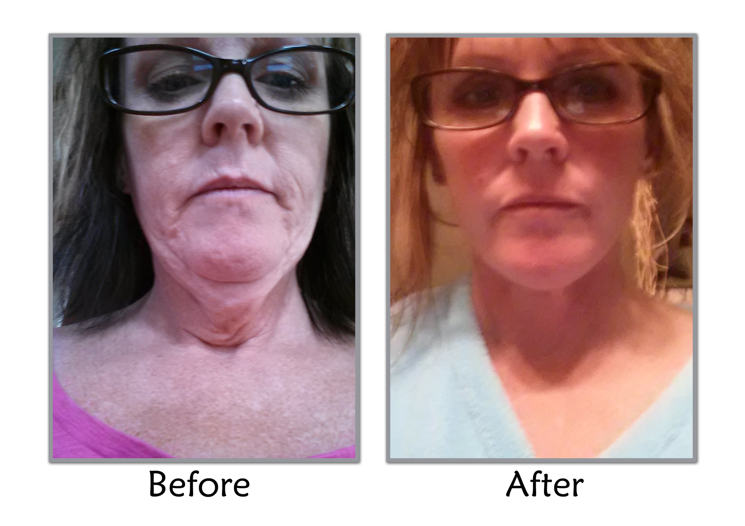 Saggy Neck From Weight Loss WeightLossLook