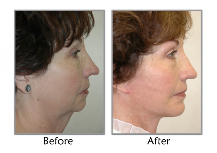 Facelift and Necklift | Utah Facelift Surgeon | SLC, Utah