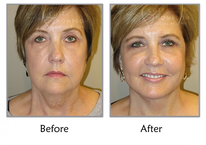 Facelift and Necklift | Utah Facelift Surgeon | SLC, Utah