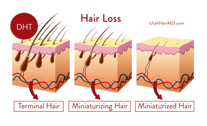 Male Pattern Baldness Treatment Slc Utah Facial Plastics