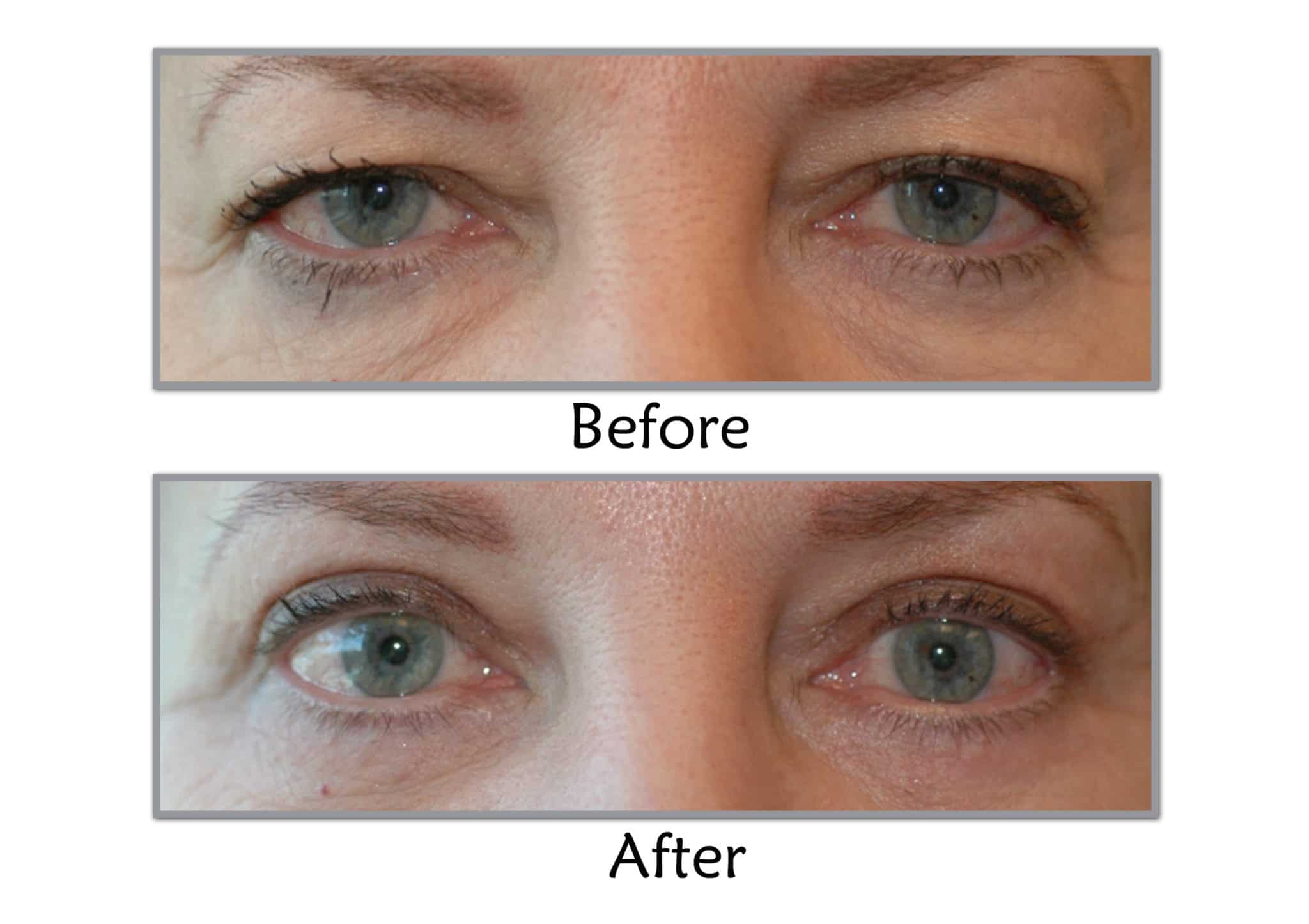  Eyelid Lift Salt Lake City Utah Blepharoplasty Draper Utah Layton