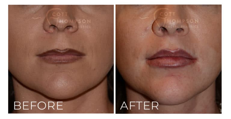 Lip Lift Recovery | Utah Facial Plastics | Layton & Draper, Ut