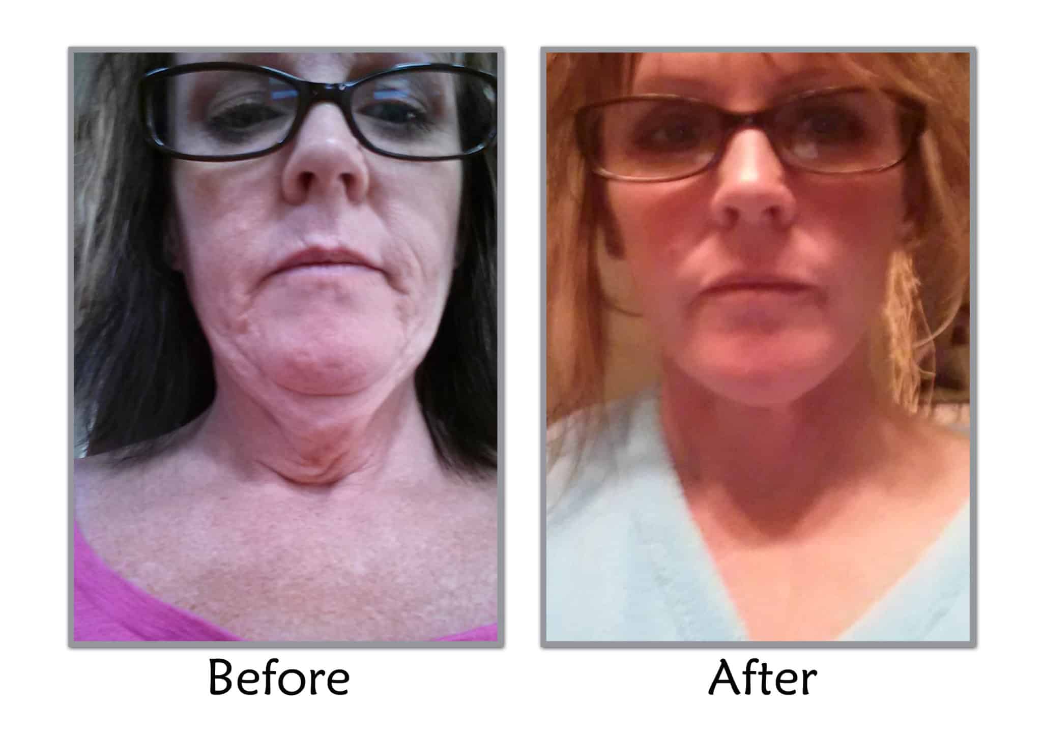 Facelift After Weight Loss In Salt Lake City Utah Facial Plastics