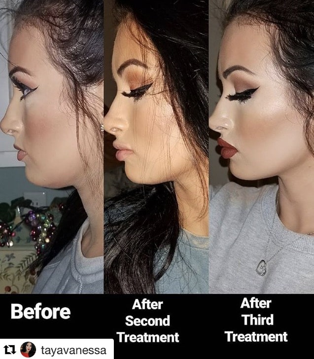 chiseled jawline before after