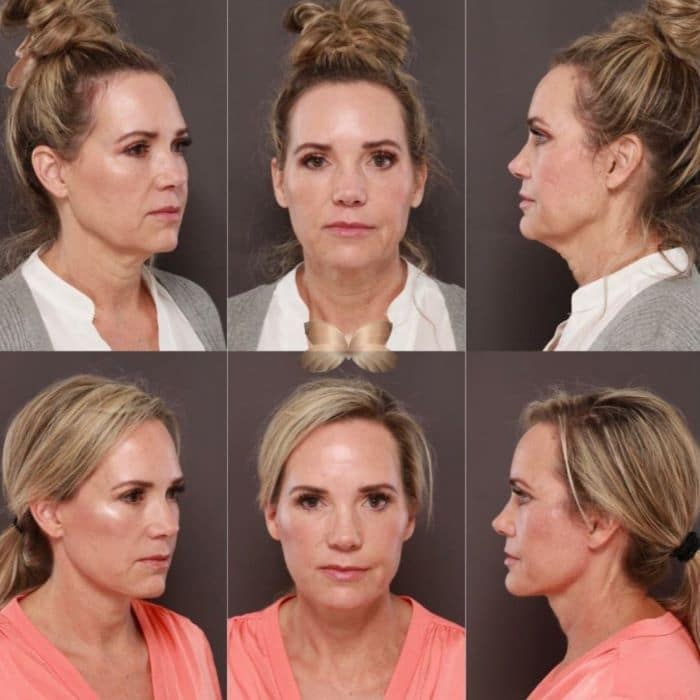 Most Popular Cosmetic Treatments for Women Over 50 - Utah Facial Plastics