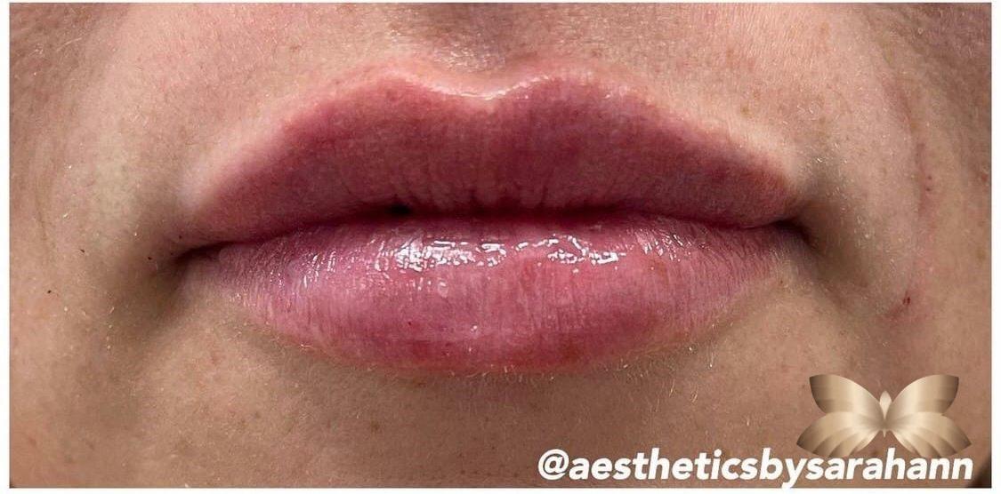 Lip Augmentation By: UFP Nurse Injector - Utah Facial Plastics