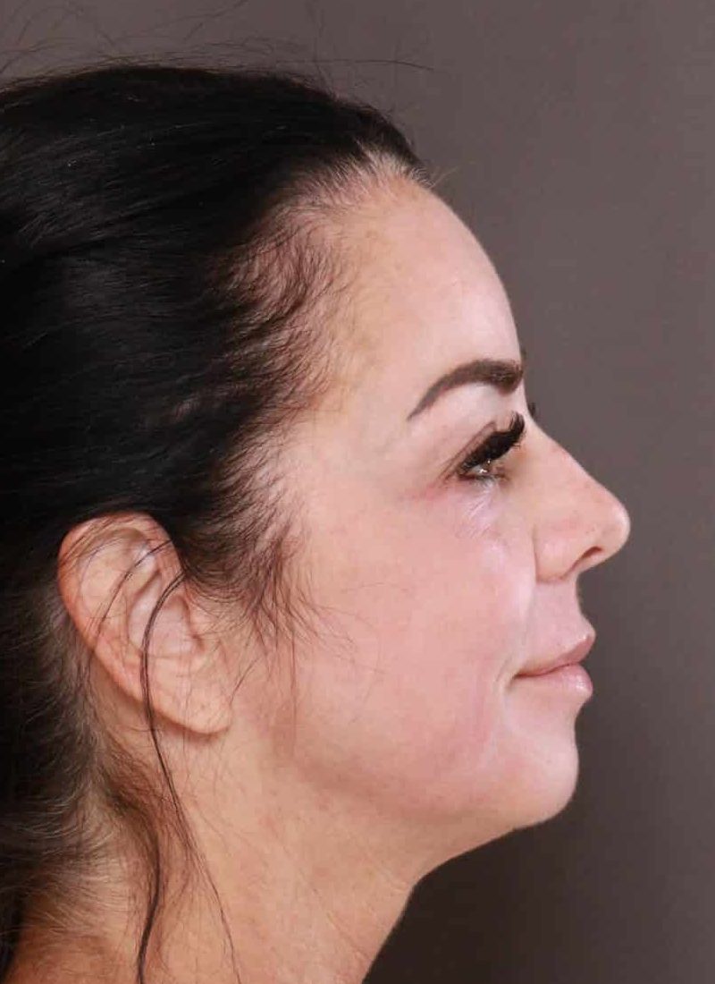 TRL Laser Resurfacing By: Katy - Utah Facial Plastics