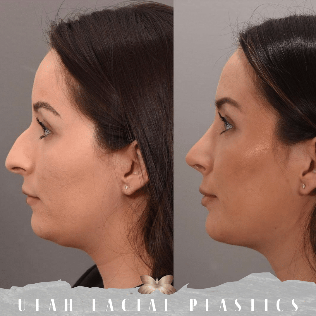 Face Contouring for Younger Patients: Improving the Jawline and Neck for a  More Attractive Look - Houston, Texas