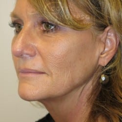 Before Image: Facelift Before and After Photos | Utah Facial Plastics 751 - left-front-oblique