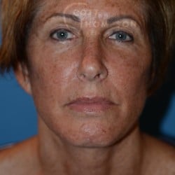 After Image: Facelift | Fat Injections | Upper Eyelids – 987 - front