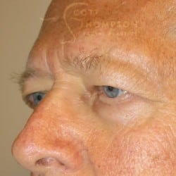 Before Image: Upper & Lower Blepharoplasty by Dr. Thompson - left-front-oblique