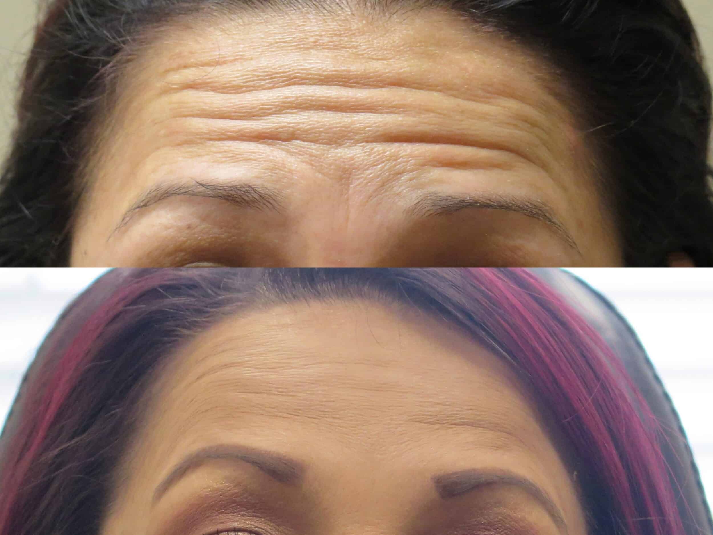 What to Do After Botox in Forehead: A Comprehensive Guide - Utah Facial  Plastics