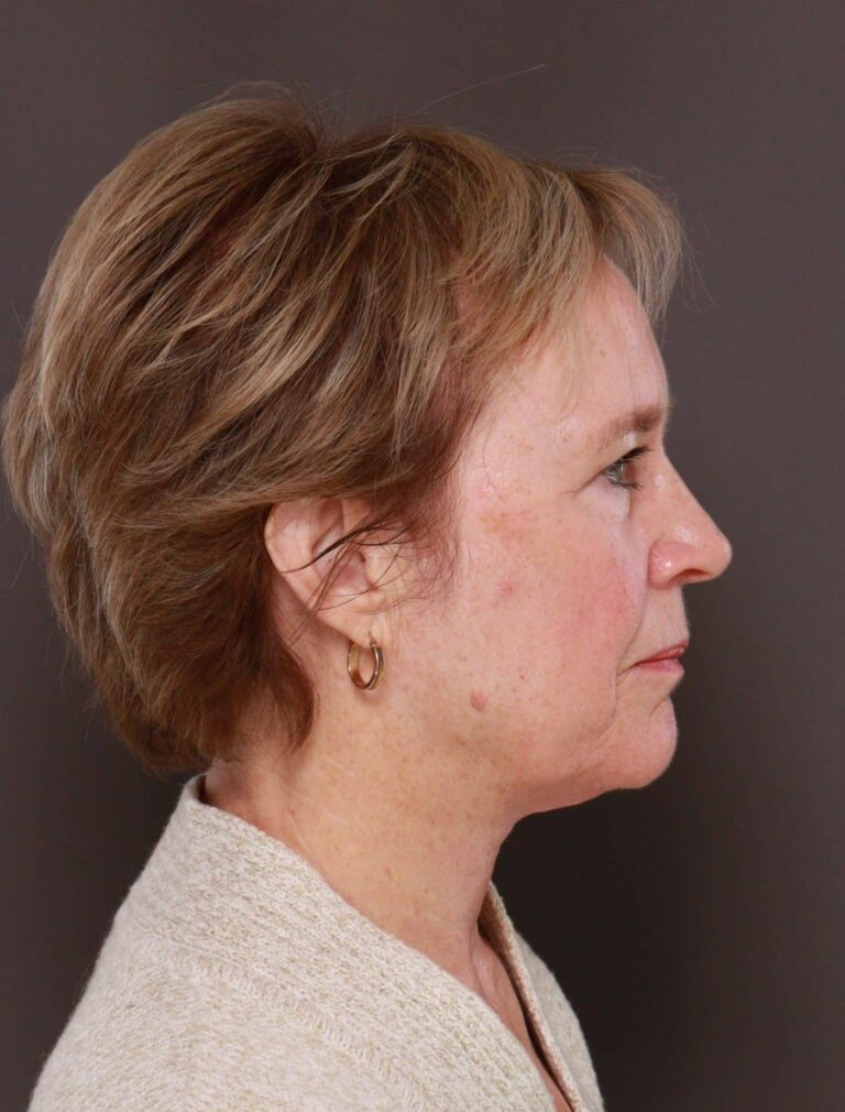 After Image: Direct Neck Lift by Dr. Henstrom - right-side