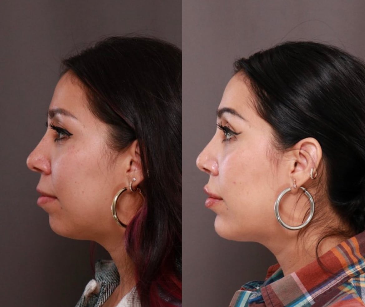 Chin Implants with Rhinoplasty Guide: Risks, Benefits, Recovery - Utah ...