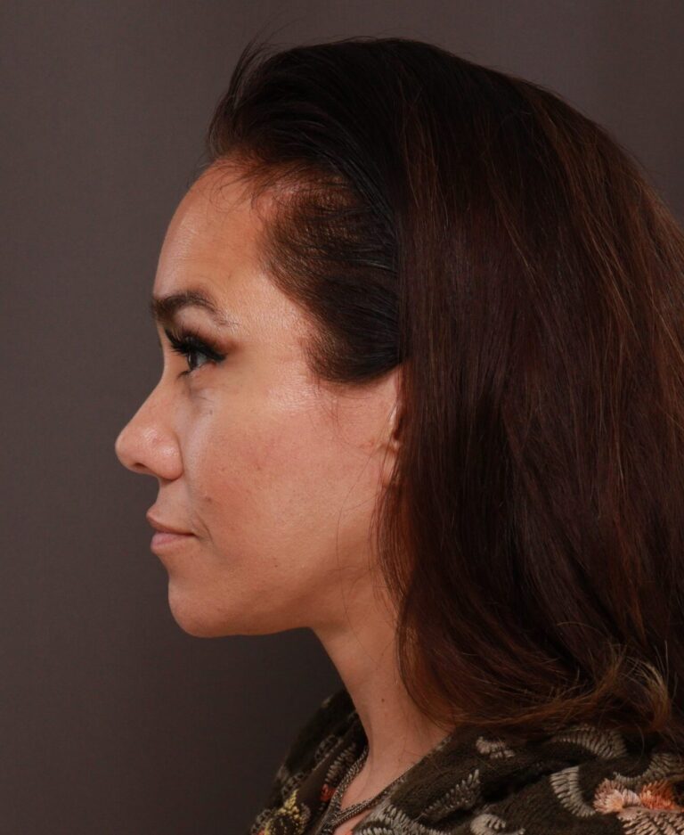 After Image: Facelift, Forehead Reduction, Upper Blepharoplasty by Dr. Thompson - left-side