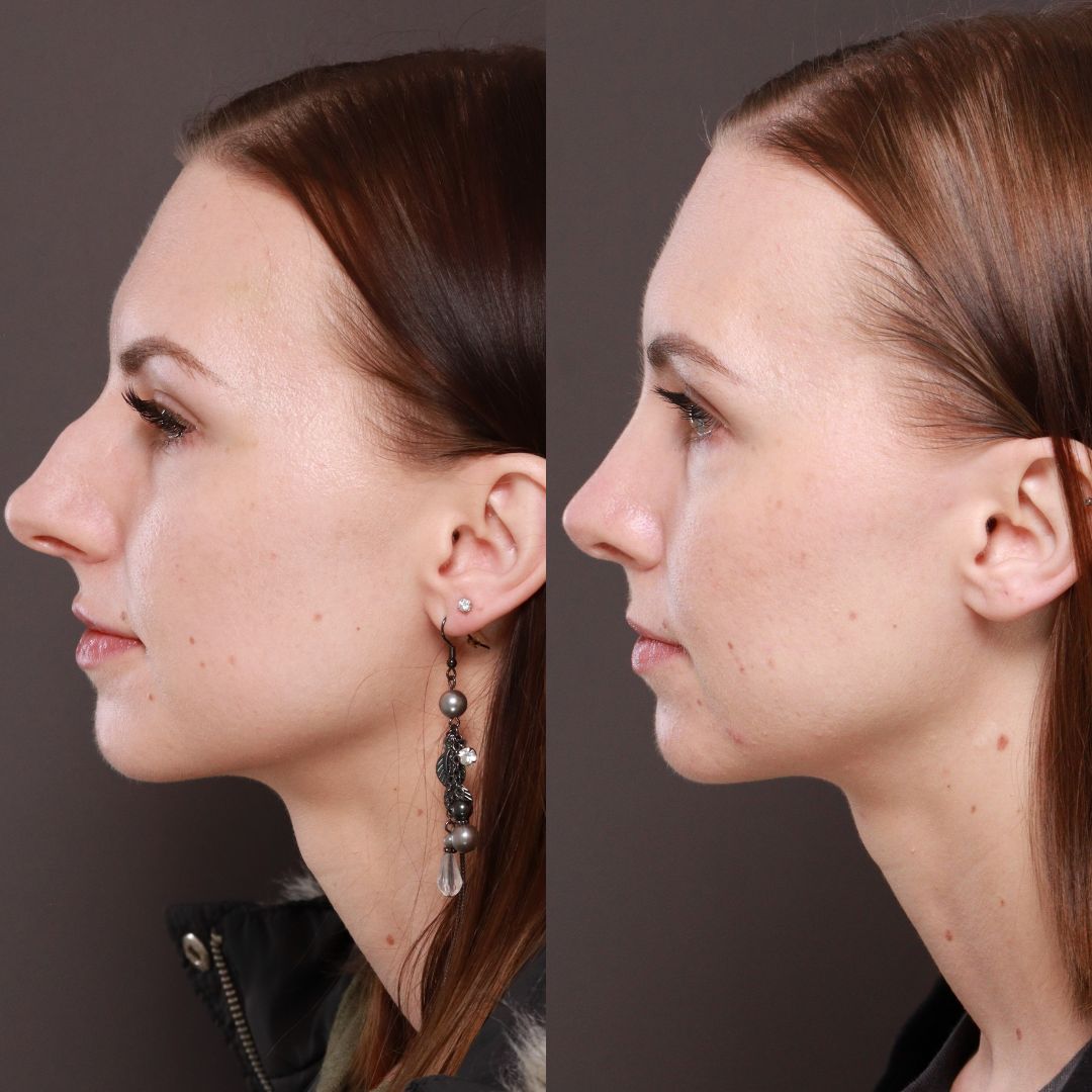 rhinoplasty before and after