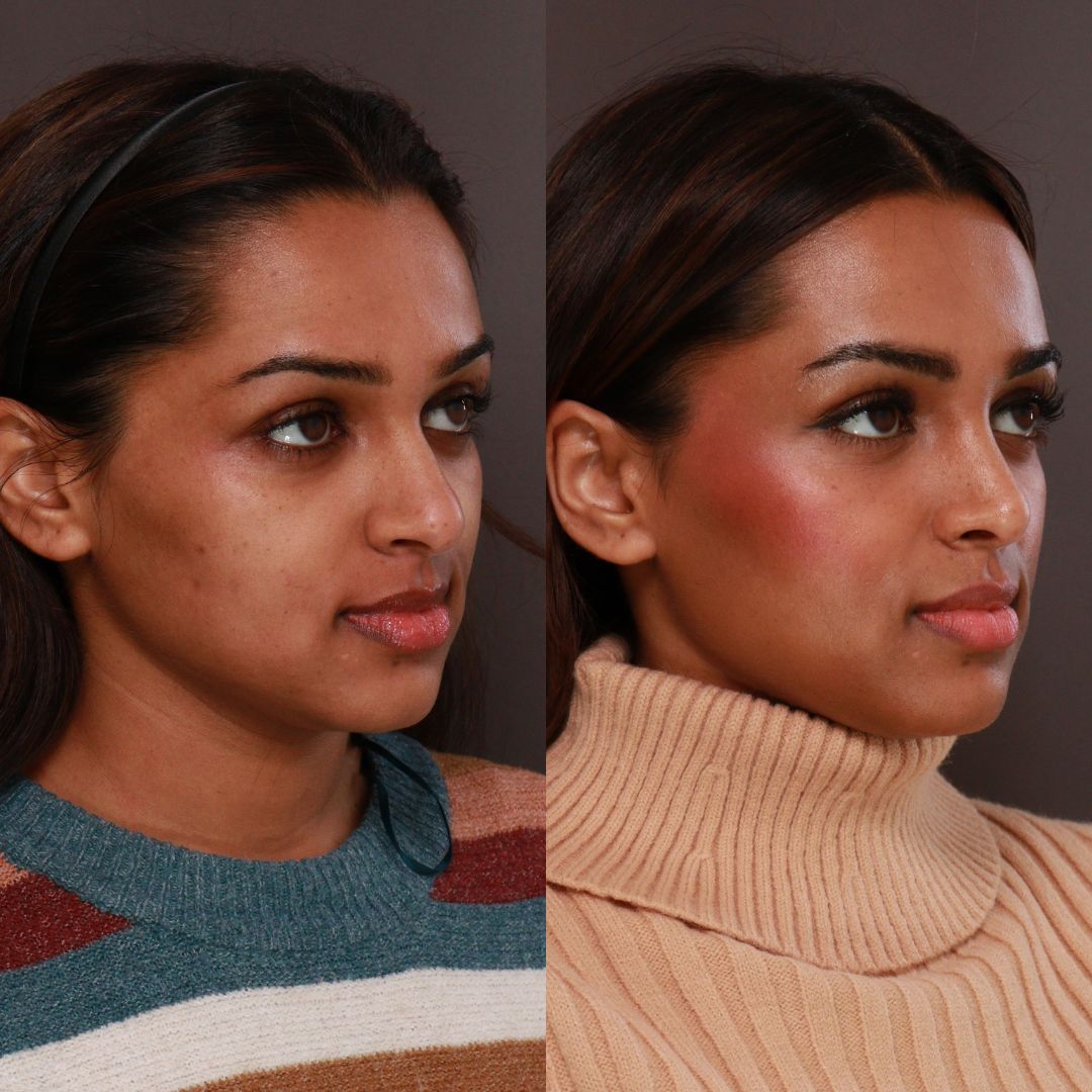 rhinoplasty before and after