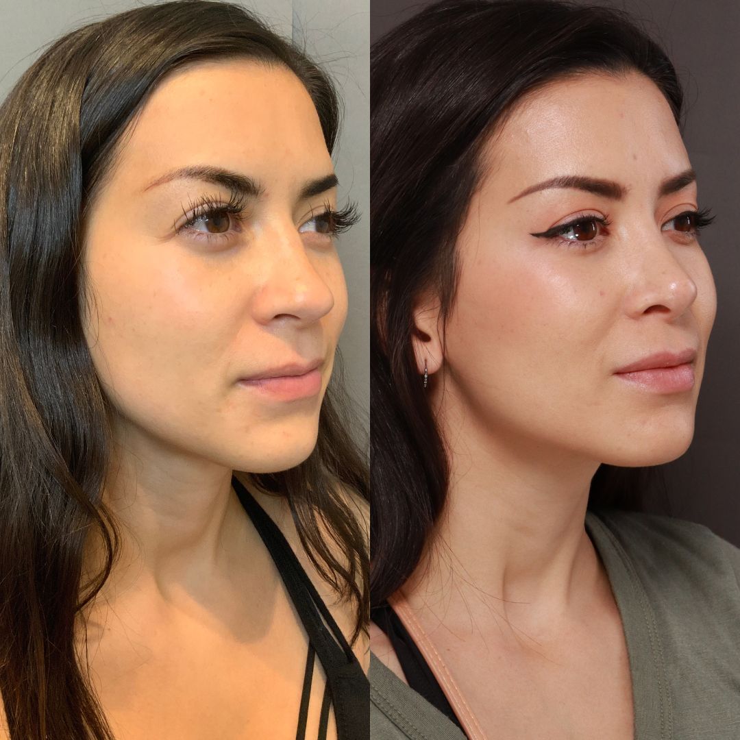 rhinoplasty