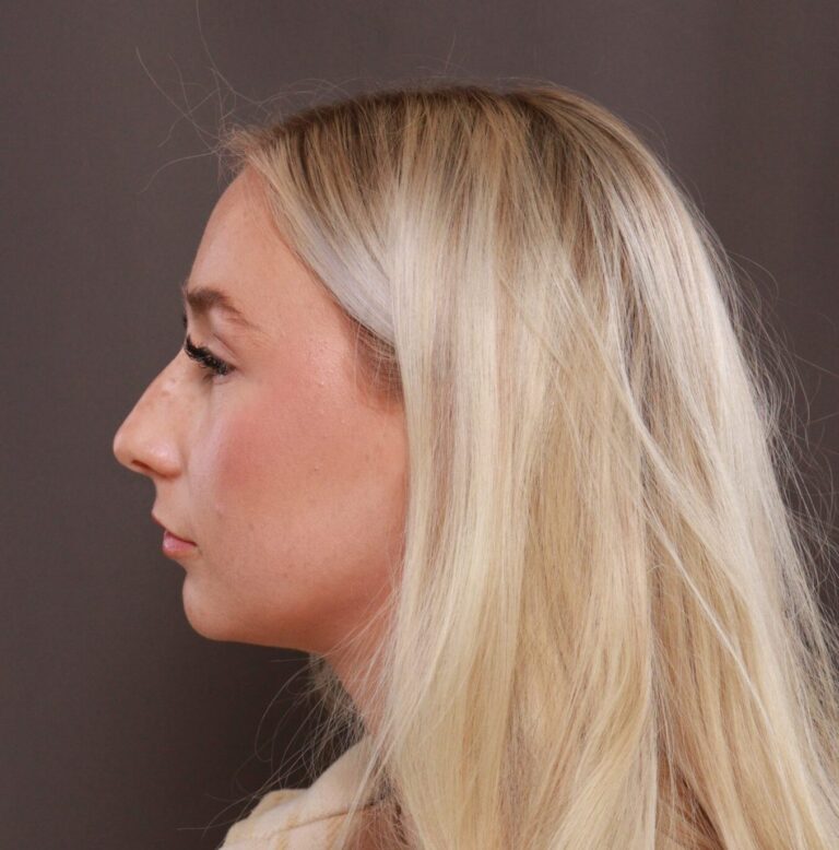 Before Image: Rhinoplasty by Dr. Henstrom - front