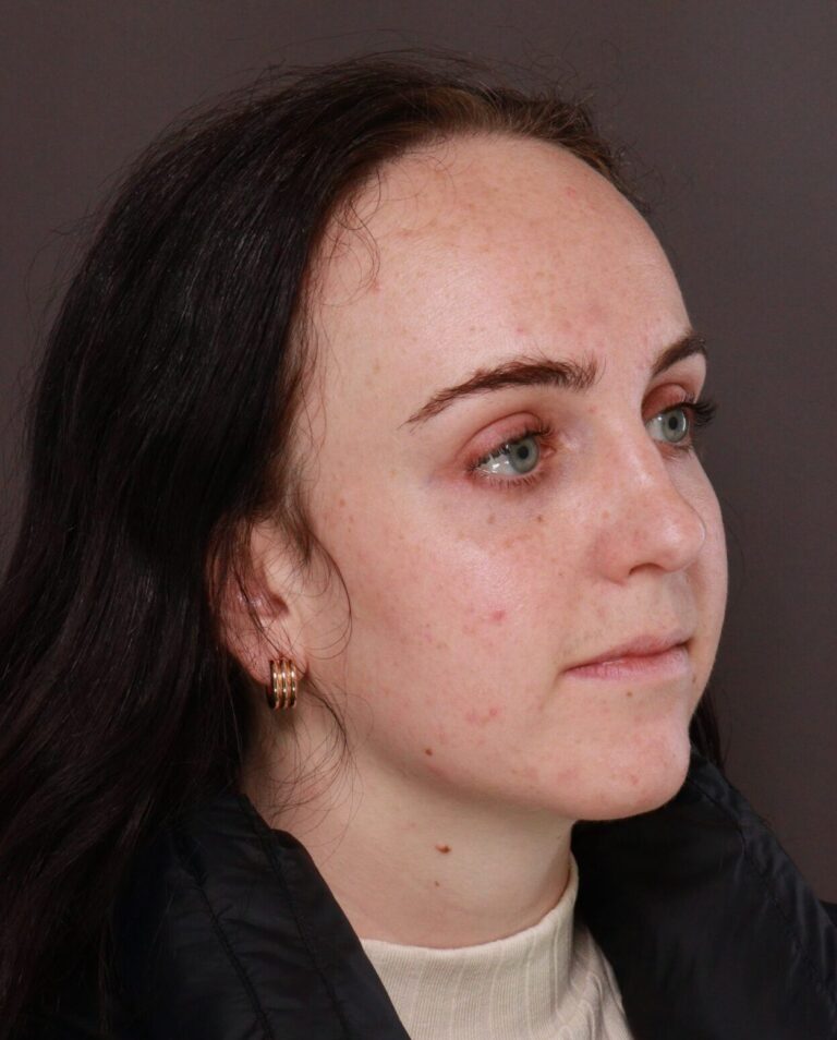 Before Image: Forehead Reduction by Dr. Manning - right-front-oblique