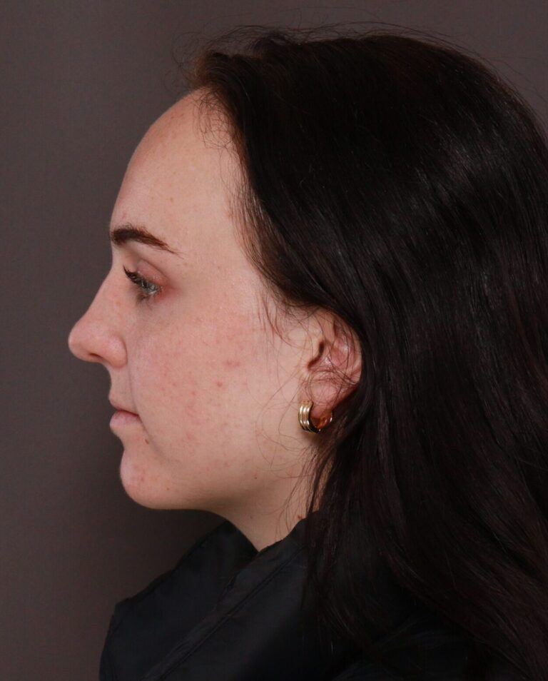 Before Image: Forehead Reduction by Dr. Manning - left-side