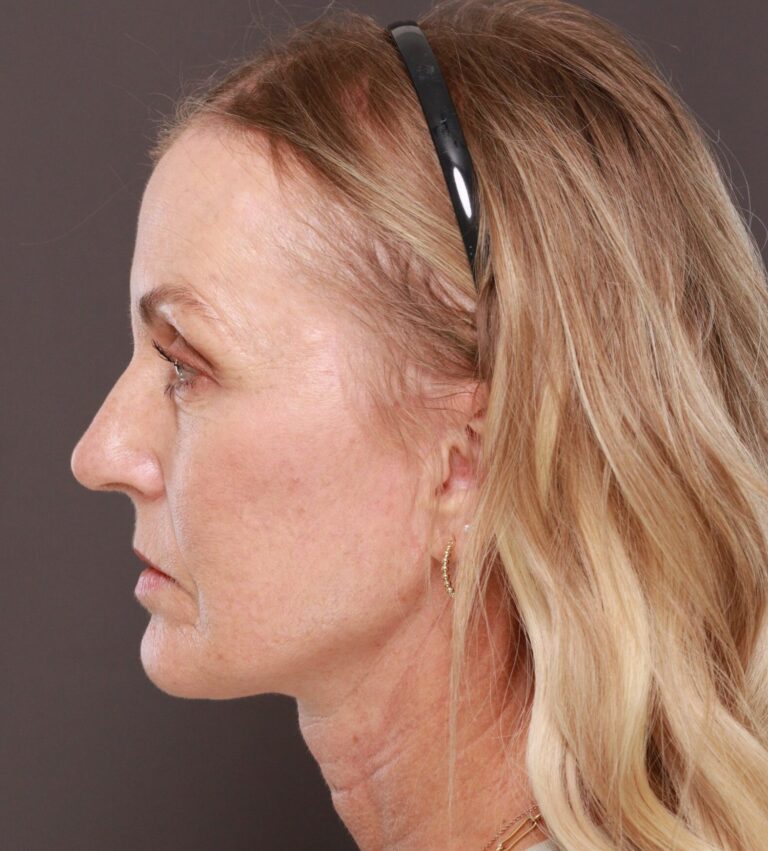 After Image: Facelift & Forehead Reduction by Dr. Thompson - left-side