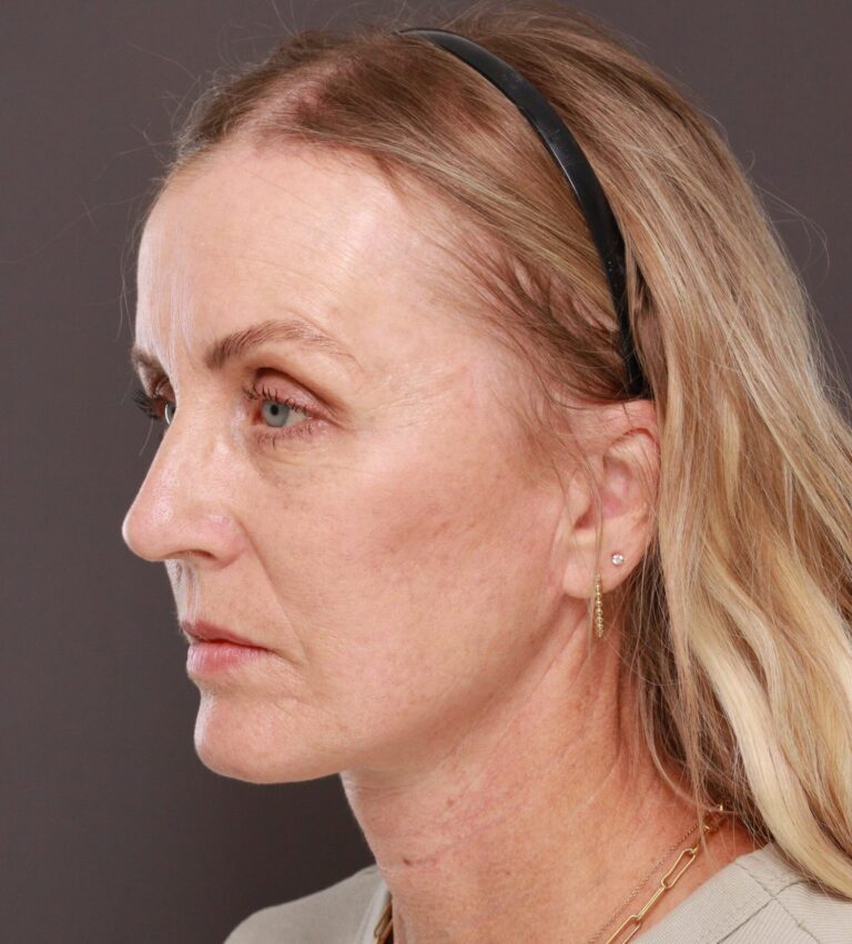 After Image: Facelift & Forehead Reduction by Dr. Thompson - left-front-oblique