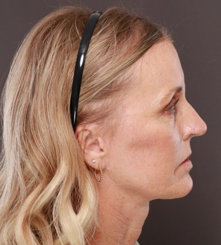 After Image: Facelift & Forehead Reduction by Dr. Thompson - right-side