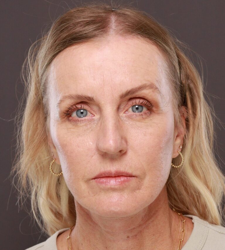 After Image: Facelift & Forehead Reduction by Dr. Thompson - front