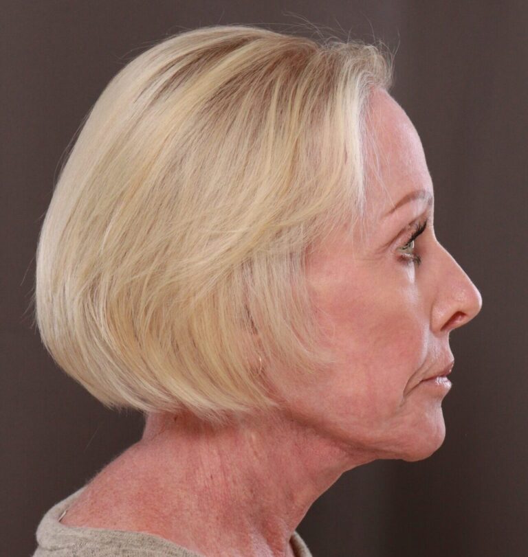 After Image: Facelift, Browlift, Lip Lift & Contour TRL by Dr. Manning - right-side