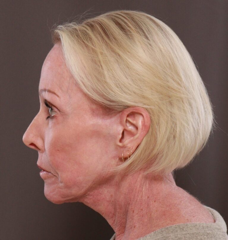 After Image: Facelift, Browlift, Lip Lift & Contour TRL by Dr. Manning - left-side