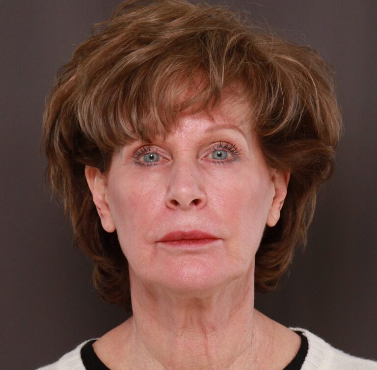 Before Image: Facelift, Lower Blepharoplasty with Periorbital Fat Grafting by Dr. Thompson - front