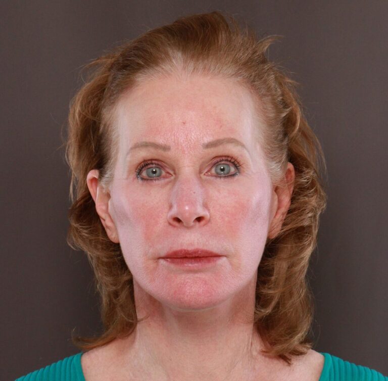 After Image: Facelift, Lower Blepharoplasty with Periorbital Fat Grafting by Dr. Thompson - front