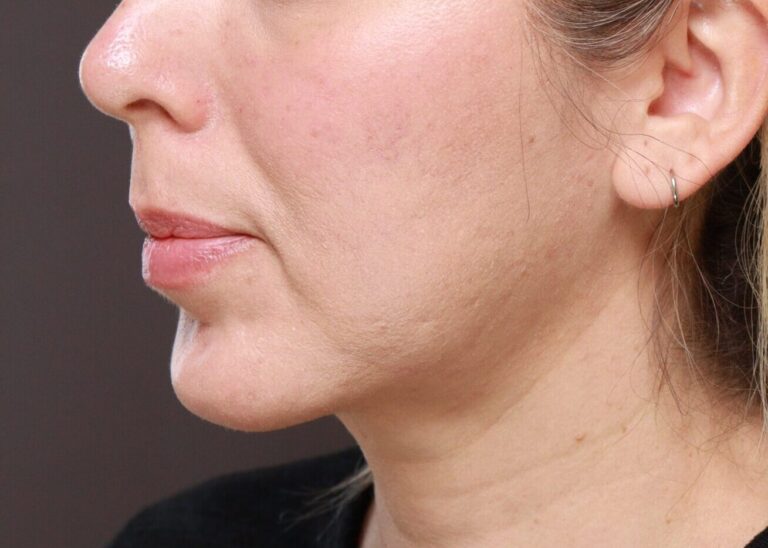 Before Image: Lip Lift by Dr. Thompson - left-front-oblique