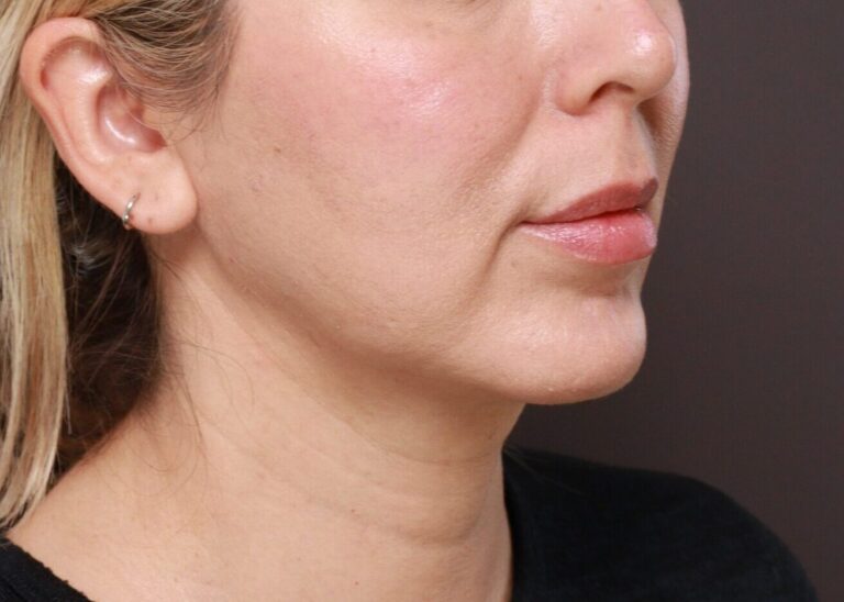 Before Image: Lip Lift by Dr. Thompson - right-front-oblique