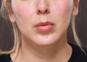 Before Image: Lip Lift by Dr. Thompson