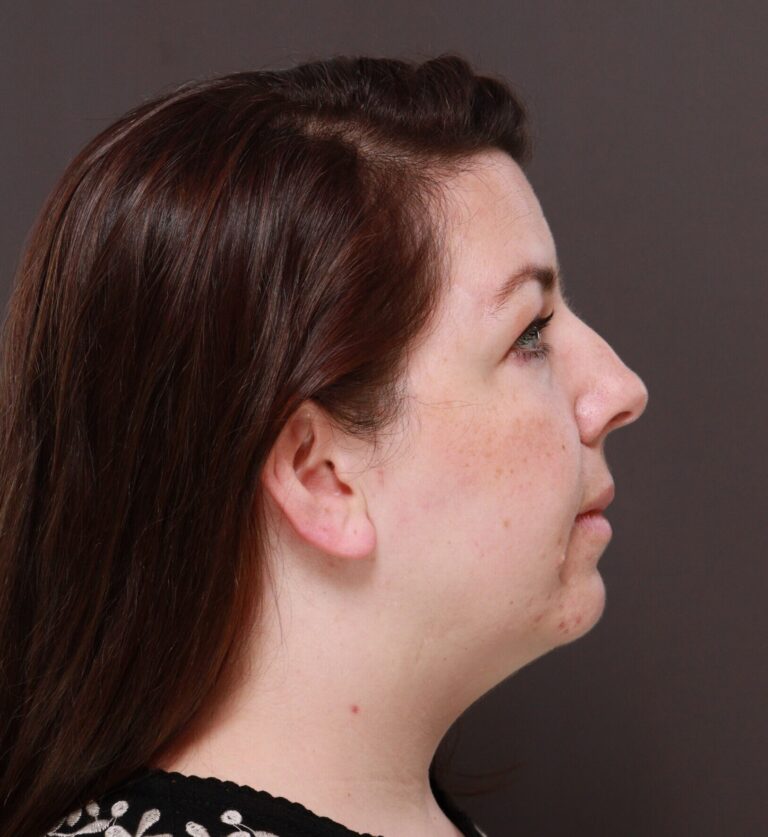 Before Image: Deep Neck Contouring by Dr. Manning - front