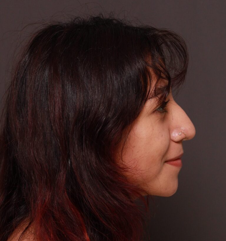 Before Image: Rhinoplasty by Dr. Manning - front