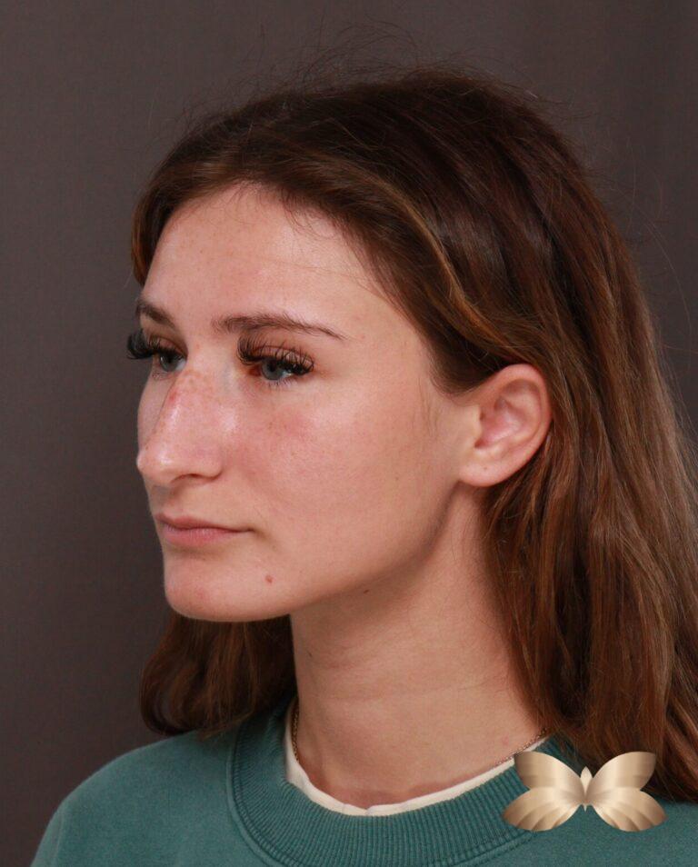 Before Image: Rhinoplasty by Dr. Manning - left-front-oblique