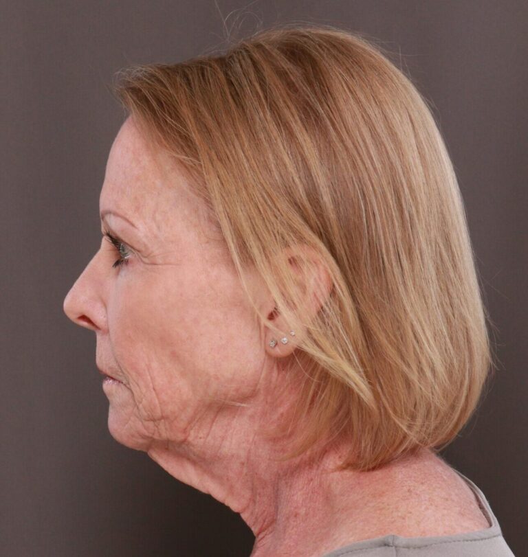 Before Image: Facelift, Browlift, Lip Lift & Contour TRL by Dr. Manning - left-side