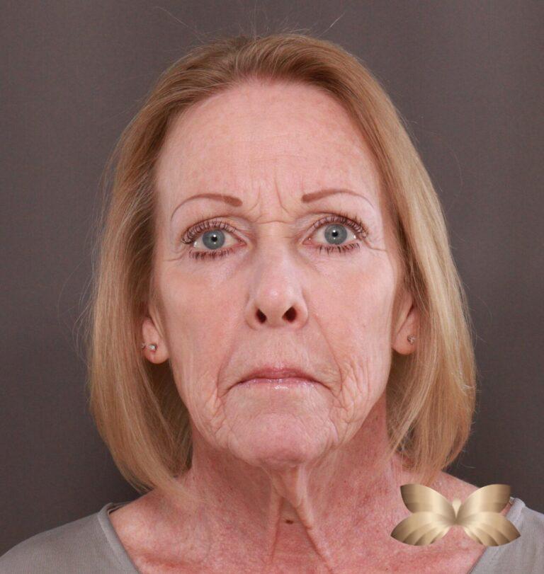 Before Image: Facelift, Browlift, Lip Lift & Contour TRL by Dr. Manning - front