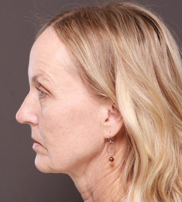 Before Image: Facelift & Forehead Reduction by Dr. Thompson - left-side