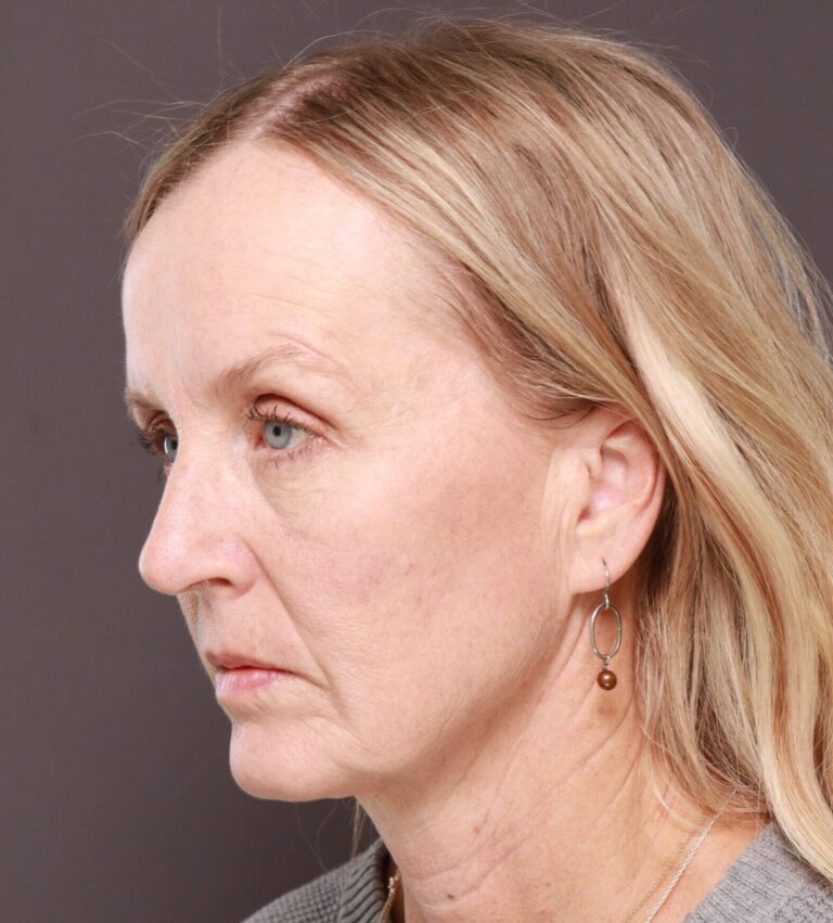 Before Image: Facelift & Forehead Reduction by Dr. Thompson - left-front-oblique