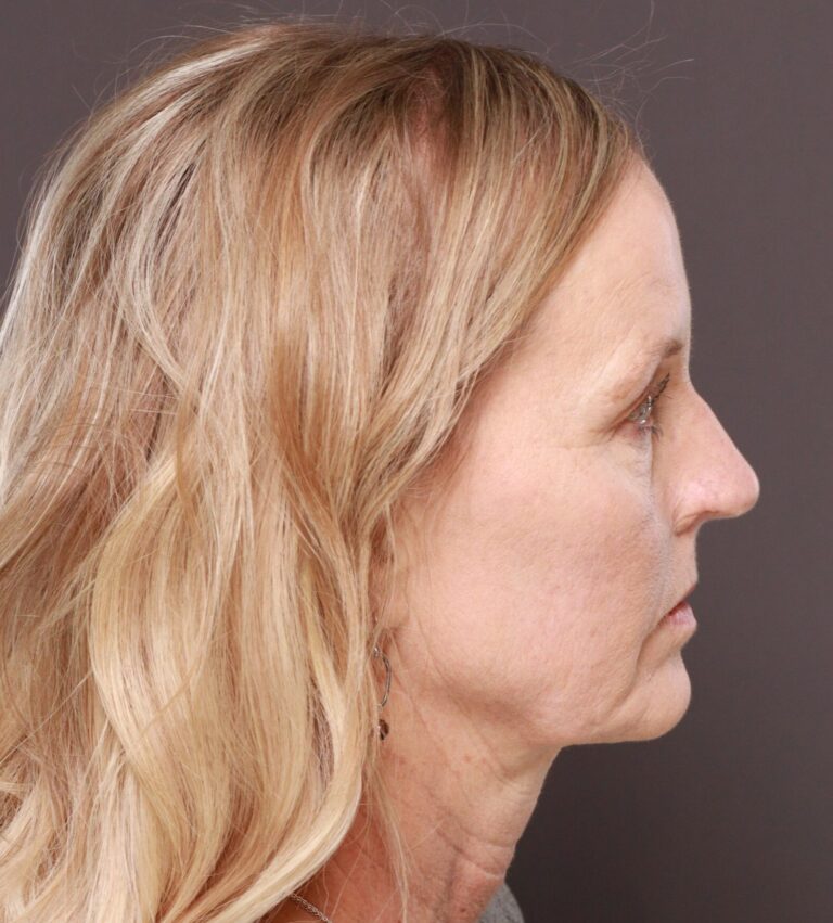 Before Image: Facelift & Forehead Reduction by Dr. Thompson - right-side