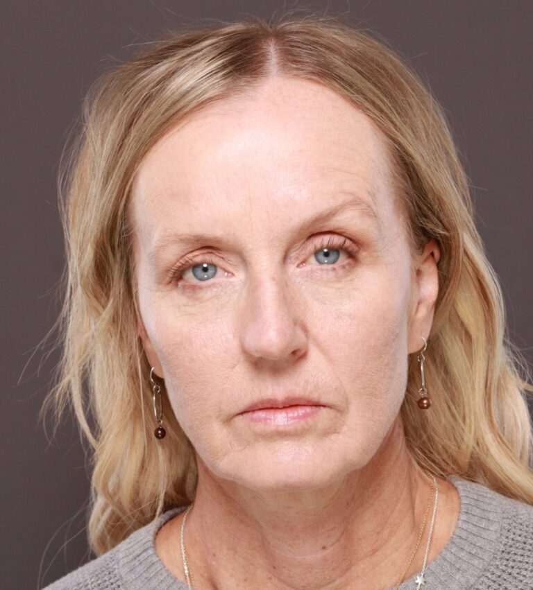 Before Image: Facelift & Forehead Reduction by Dr. Thompson - front