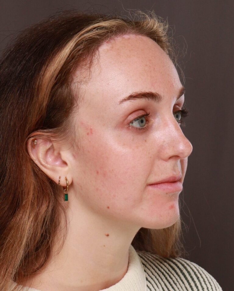 After Image: Forehead Reduction by Dr. Manning - right-front-oblique