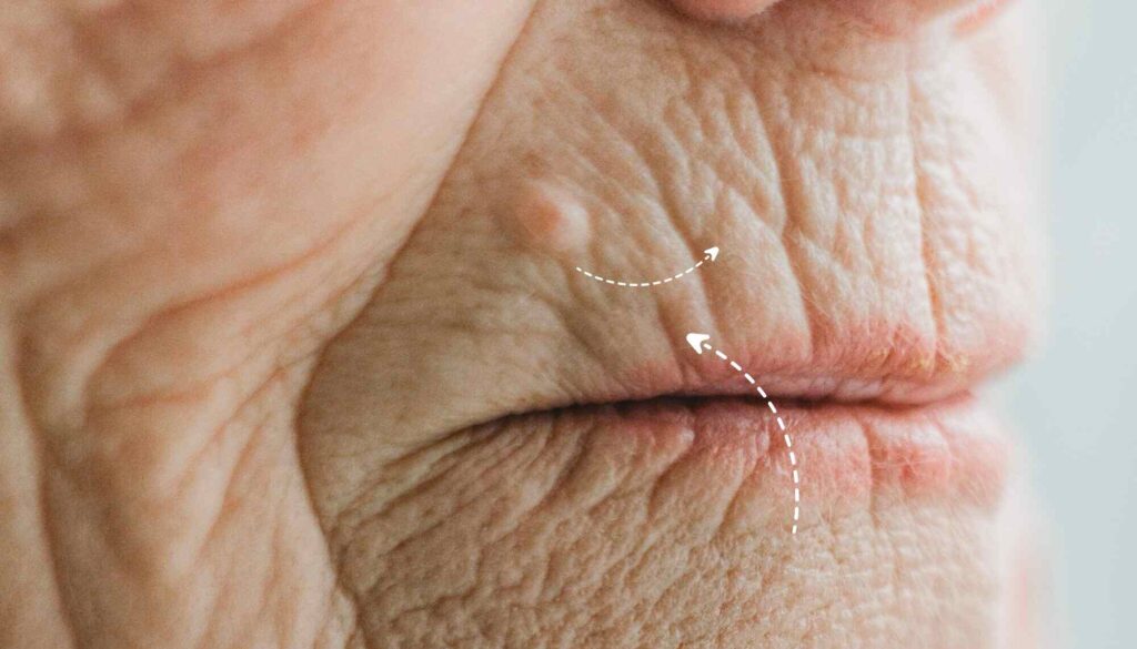 Lip Wrinkles