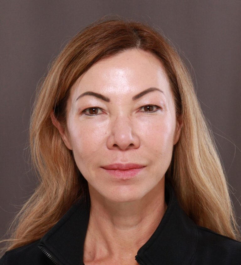 Before Image: Upper Blepharoplasty by Dr. Manning - front