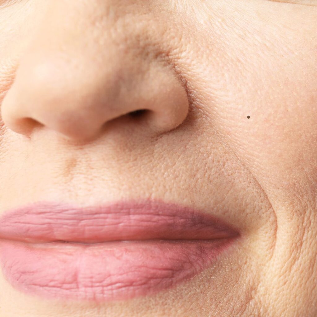 lip lift