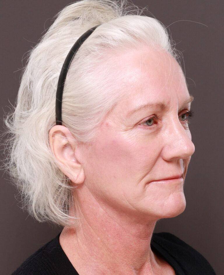 After Image: Facelift & Lower Blepharoplasty by Dr. Thompson, Contour TRL by Dr. Manning - right-front-oblique